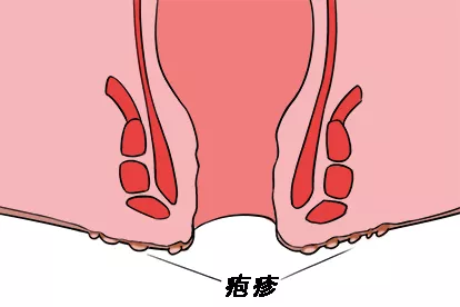 肛周单纯疱疹图片