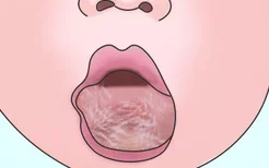 舌头淋巴管畸形图片