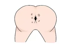 肛门口长透明水泡图片