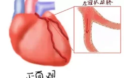 左心室壁冠脉垂直供血的图片高清