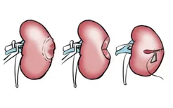 肾错构瘤微创手术图解
