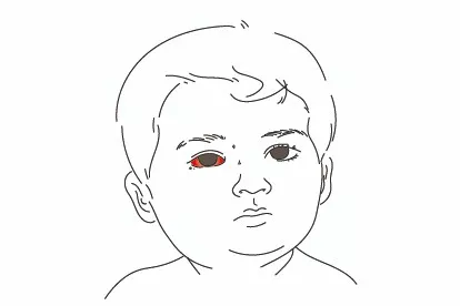 宝宝眼睛充血图片