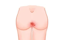 肛门肉瘤图片和症状