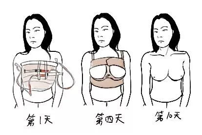 假体隆胸后图