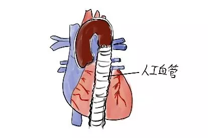 主动脉夹层人工血管图片