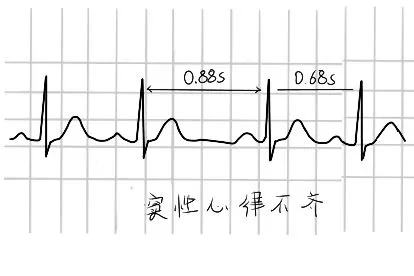 心律失常图片