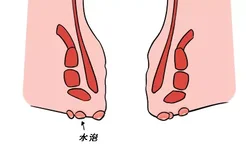 肛门瘙痒起水泡图片