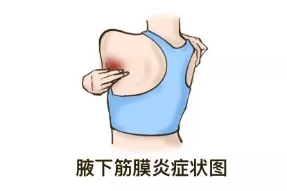腋下筋膜炎症状图