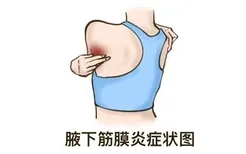 腋下筋膜炎的症状图