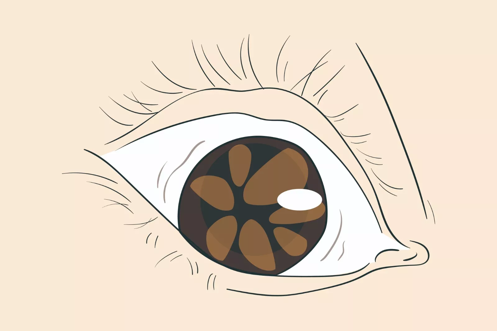 瞳孔残膜图片