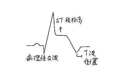 下壁心梗心电图图片