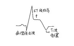 下壁心梗心电图图片