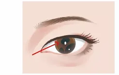 瞳孔残膜图片