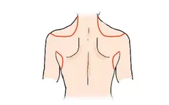 肩胛骨吸脂是哪个部位图片