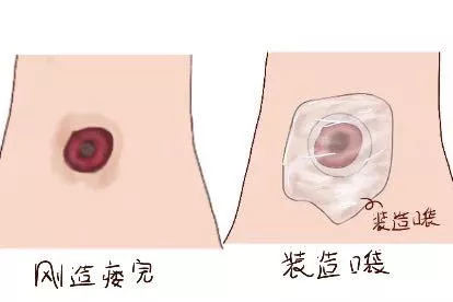 直肠癌造瘘口图片