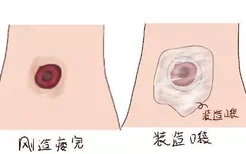 直肠癌造瘘口各阶段的图片