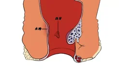 痔疮手术肉芽和水肿区别图片