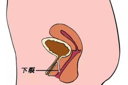 女性尿道口下裂图