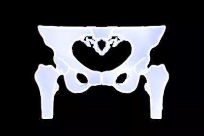 胯骨CT图片