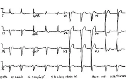 左心室肥大心电图图片