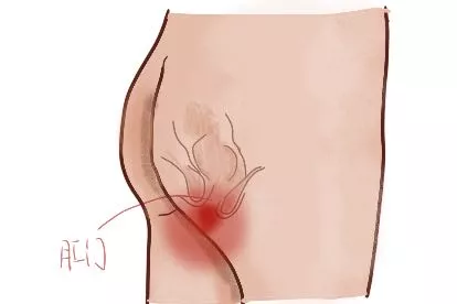 肛区疼痛位置图