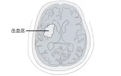 左侧基底节区脑出血图片