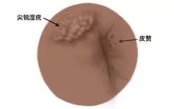 肛周皮赘和尖锐的区别图