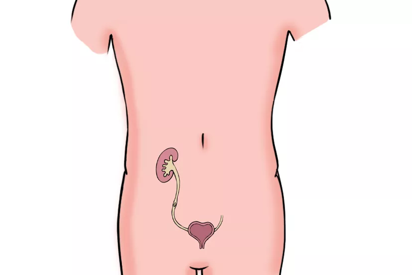 输尿管腹段结石图