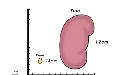 肾结石12mmx7mm有多大图片