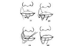 下唇缺损皮瓣修复图解