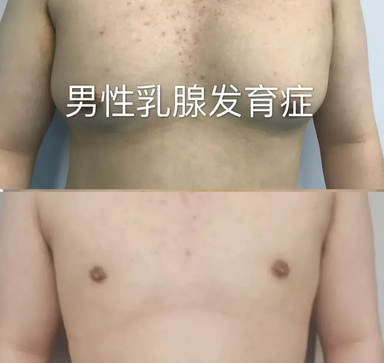 男性乳腺增生症术后需要心理干预？