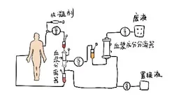 双重血浆置换示意图