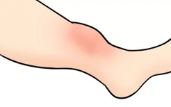 小腿肌腱炎的症状图片