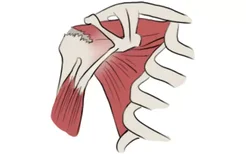 肩袖断裂受伤机制图