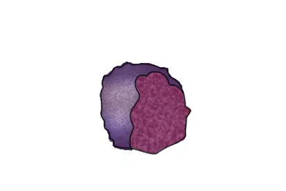 反应性淋巴细胞图