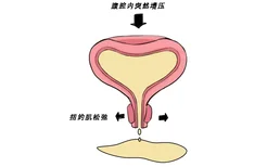 压力性尿失禁图片