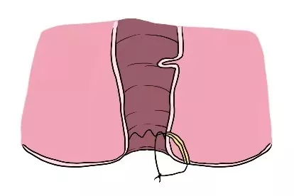 肛周脓肿挂线原理图片