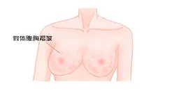 假体隆胸褶皱图片