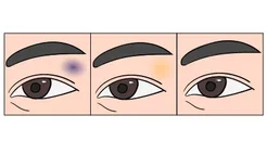 眼睛青紫恢复过程图