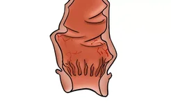 直肠黏膜充血水肿图片