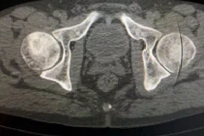 股骨头坏死CT图