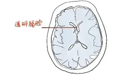 透明隔腔解剖图