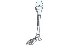 小腿胫骨髓内钉图片