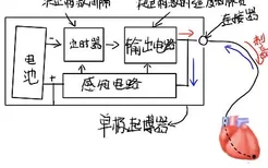 心脏起搏器的工作原理示意图