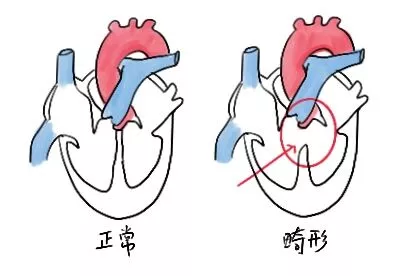 心脏畸形图片