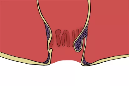 肛周结节图片