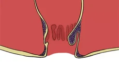 肛周结节图片