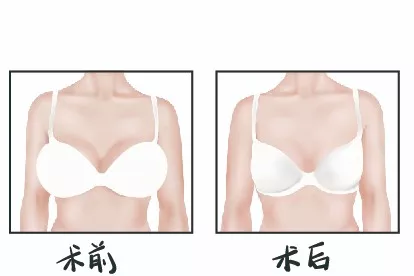 缩胸手术案例图