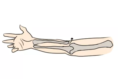 肱桡关节脱位图片