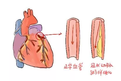 吸烟对心脏的危害图片